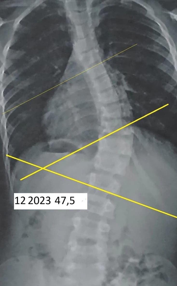 Dokumentacja RTG przed terapią — Łukasz, 12 lat